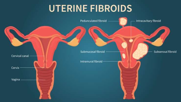 The Effect of Fibroids on Fertility and Pregnancy