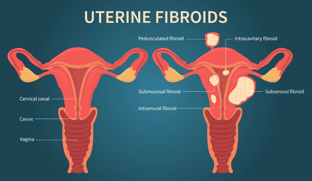 The Effect of Fibroids on Fertility and Pregnancy