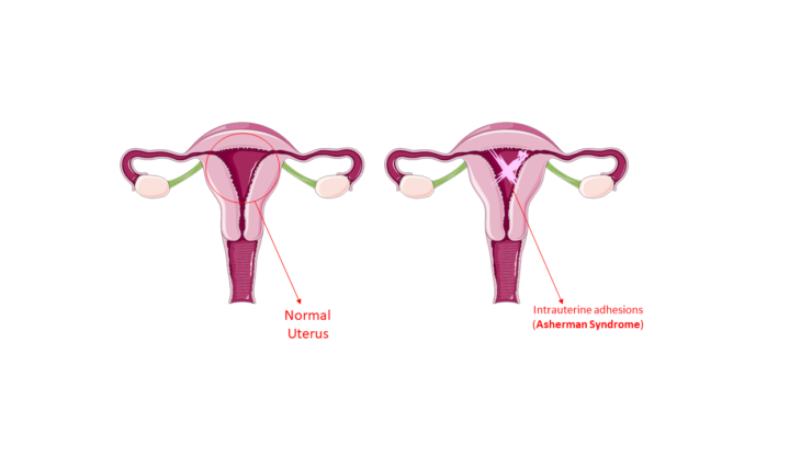 Intrauterine Adhesions (Asherman Syndrome): Infertility and Recurrent Miscarriage